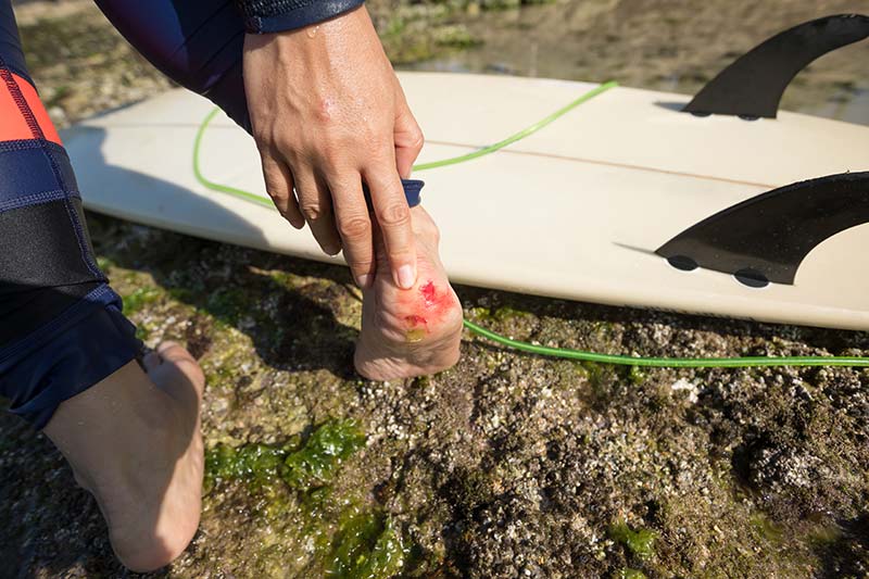 canggu-spot-surf-bali-blessure