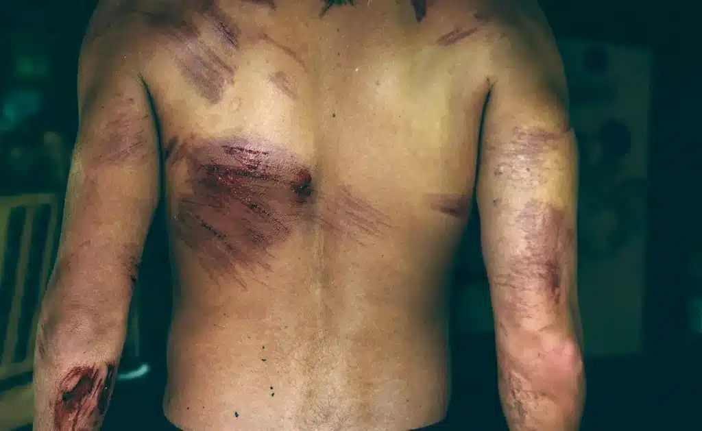 Blessures de corail sur le dos d'un surfeur à Bali